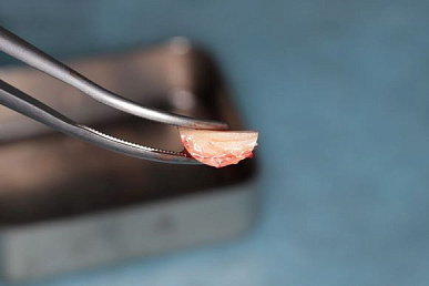 Transfer-Control - набор для горизонтального и вертикального наращивания костной ткани с помощью костных трансплантатов № 4 Transfer-Control - набор для горизонтального и вертикального наращивания костной ткани с помощью костных трансплантатов № 4